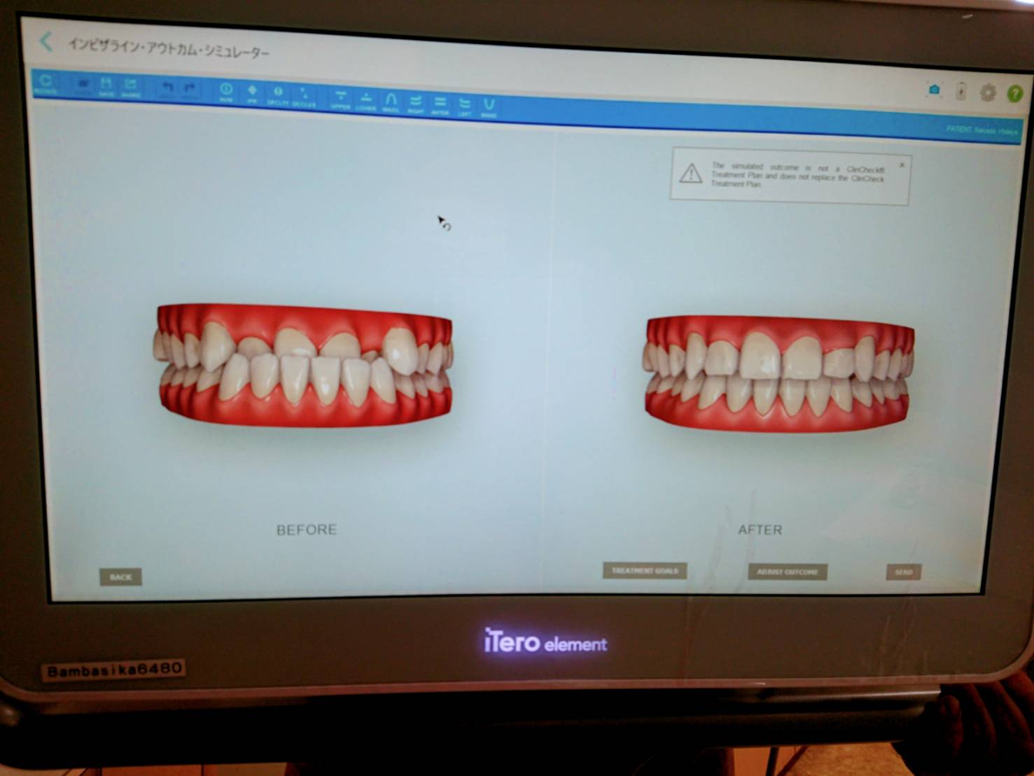 矯正後の歯並びを確認できる